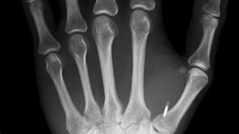 how far can rfid chips implant|The surprising truths and myths about microchip implants .